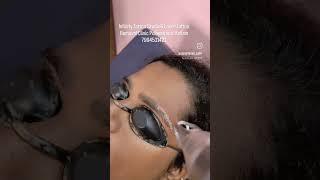Laser Eyebrow Tattoo Removal #eyebrowtattoo #eyebrowtattooremoval #microblading #pmu #kerala #kollam