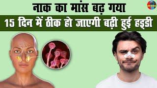 नाक का मांस बढ़ गया 15 दिन में ठीक हो जाएगी | Enlargement of nose | Sinusitis #homeremedies #tips