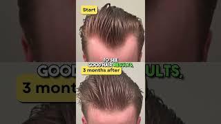 Microneedling your scalp to regrow hair