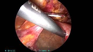 Lap lysis of adhesions for SBO