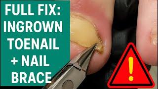 Full Fix: Ingrown Toenail + Nail Brace Treatment