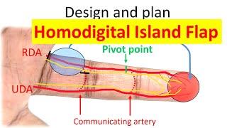 How to design and perform a homodigital island flap