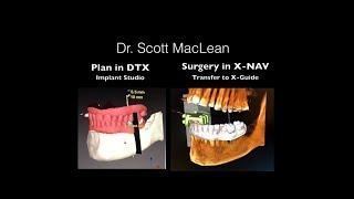 DTX file to X-Guide Guided Surgery - How to do Navigational Surgery