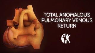 Total Anomalous Pulmonary Venous Return