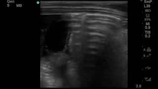 The Gut Point of Pneumoperitoneum