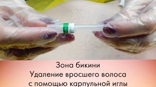 Удаление вросшего волоса зона бикини\Removing ingrown hair bikini area