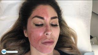 PRP with microneedling and Plasma Injections