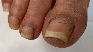 Transformação Incrível! Pedicure Extrema em Pé Negligenciado com Unhas Enormes!