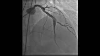 Figure 3: An illustration of LAD artery ectasia with a visible clot.