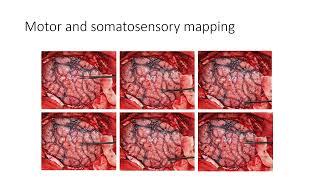 Neuromonitoring in Epilepsy Surgery: Kaloyan Gabrovski, MD (Bulgaria)
