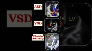 Congenital Heart Defects on Echo: ASD, VSD & More! #congenitalheartdisease