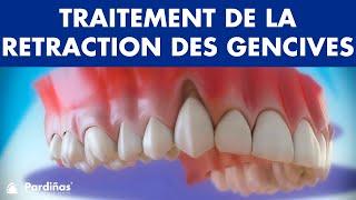 Récession Gingivale – Traitement de la retraction des gencives ©