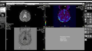 Обучающее видео «Перфузия МРТ Т2»