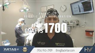 Hair By Dr. Max, Restoration Center - 1700 FUE Grafts ARTAS® Robotic Hair Restoration