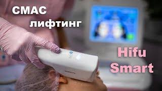 СМАС лифтинг лица! Омоложение на 10 лет БЕЗ операции!!! Обзор аппарата Hifu Smart