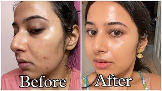 Simple Tretinoin Night Skincare Routine for Acne free Glowing Skin #skincare #skincareroutine