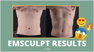 EMSCULPT ( Before & After’s ) - Is it *WORTH* it ?! & Does it WORK?! | Quinn Clinics Bristol