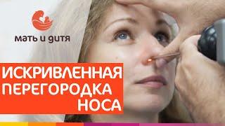 Как проходит септопластика и реабилитация после операции? #искривление #реабилитация  #ринопластика