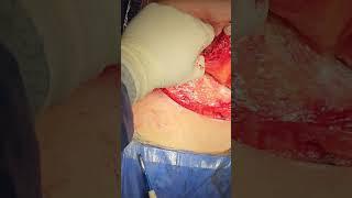 Anterior intercostal artery perforator flap (AICAP) for partial breast reconstruction