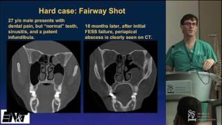 Odontic Sinus Disease - Al Pokorny, MD