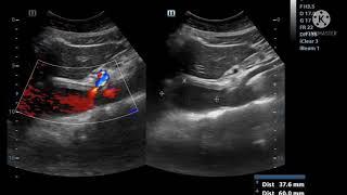Case of AAA.. Abdominal Aortic Aneurysm.