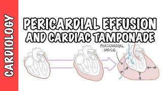 Cardiac Tamponade - pericardial effusion, causes, pathophysiology, investigations and treatment