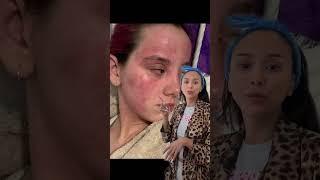 Caitlin’s progress pics ️️️ #skin