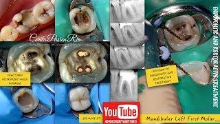 ONE VISIT ENDOdontic ReTreatment molar i3 Gold denjoy free fill konservasi gigi