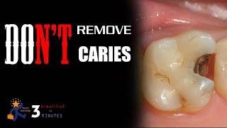 Caries removal technique