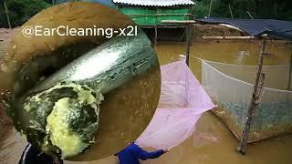 So Terrifying: Infected, Stinky, Dry Ear Wax Removal | ASMR | EP 39