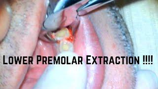 Lower premolar extraction