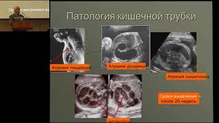 19.02.2017 - Пренатальная диагностика пороков развития у детей