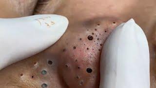 Treatment of Blackheads and Hidden Acne at Loan Nguyen Spa | 031