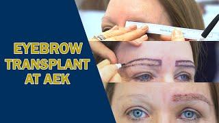 Eyebrow Transplant at AEK Hair Clinic #eyebrowtransplant