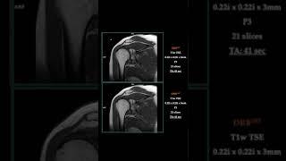 MRI – FAST SHOULDER w/DRB