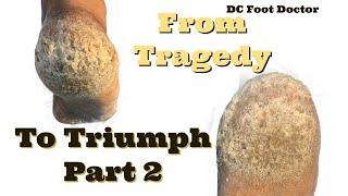 From Tragedy to Triumph: Part 2: Thick, Cracked, Callused Heels