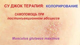 Лечении абсцесса аппликационным методом  Суджок Ки терапии