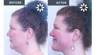 Different Types of Neck Lift - Part 1 | 8 West Clinic - Vancouver, BC