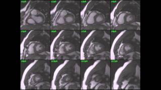Nucradshare.wordpress.com: Cardiac MRI cine SSFP segmentation