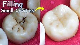 The Amazing Way of Doing Tooth Restoration | Repairing Pit and Fissure Caries