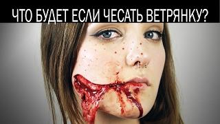 Что будет если чесать ветрянку