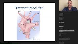 Сосудистые кольца трахеи у детей - Степаненко Н.С.