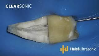 51 ClearSonic   Helse Ultrasonic