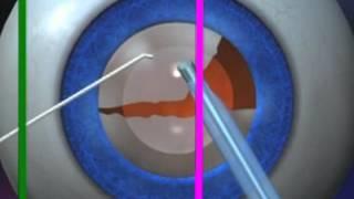 Common Eye Disease & Their Treatment Dr Vidushi Pandey SuVi Eye Institute Kota India