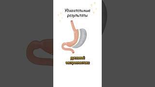 КАК ПОХУДЕТЬ НАВСЕГДА? Операция по уменьшению желудка #меднавигатор #ожирение #лишнийвес