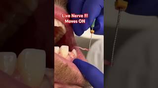 Live NERVES !! Root Canal