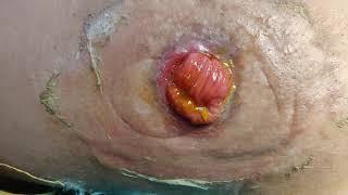 Ileostomy - See how it looks