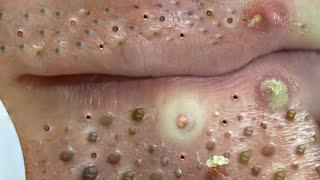 Big Cystic Acne Blackheads Extraction Blackheads & Milia, Whiteheads Removal Pimple Popping # 703