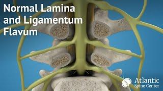 Normal Lamina and Ligamentum Flavum