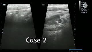 Cases of worm infestation in adults (Ascaris lumbricoid) at Procare diagnostic centre.